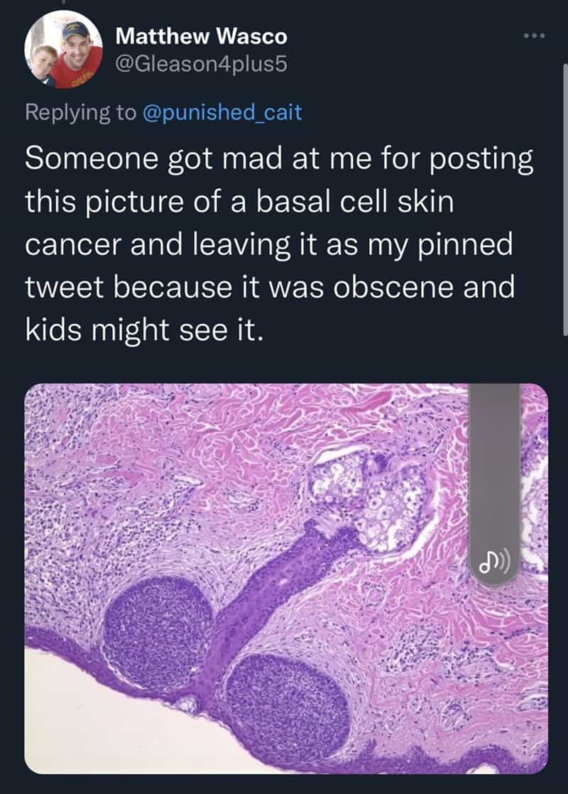 Someone got mad at me for posting this picture of a basal cell skin cancer and leaving it as my pinned tweet because it was obscene and kids might see it.