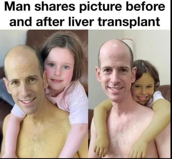 Man shares picture before and after liver transplant