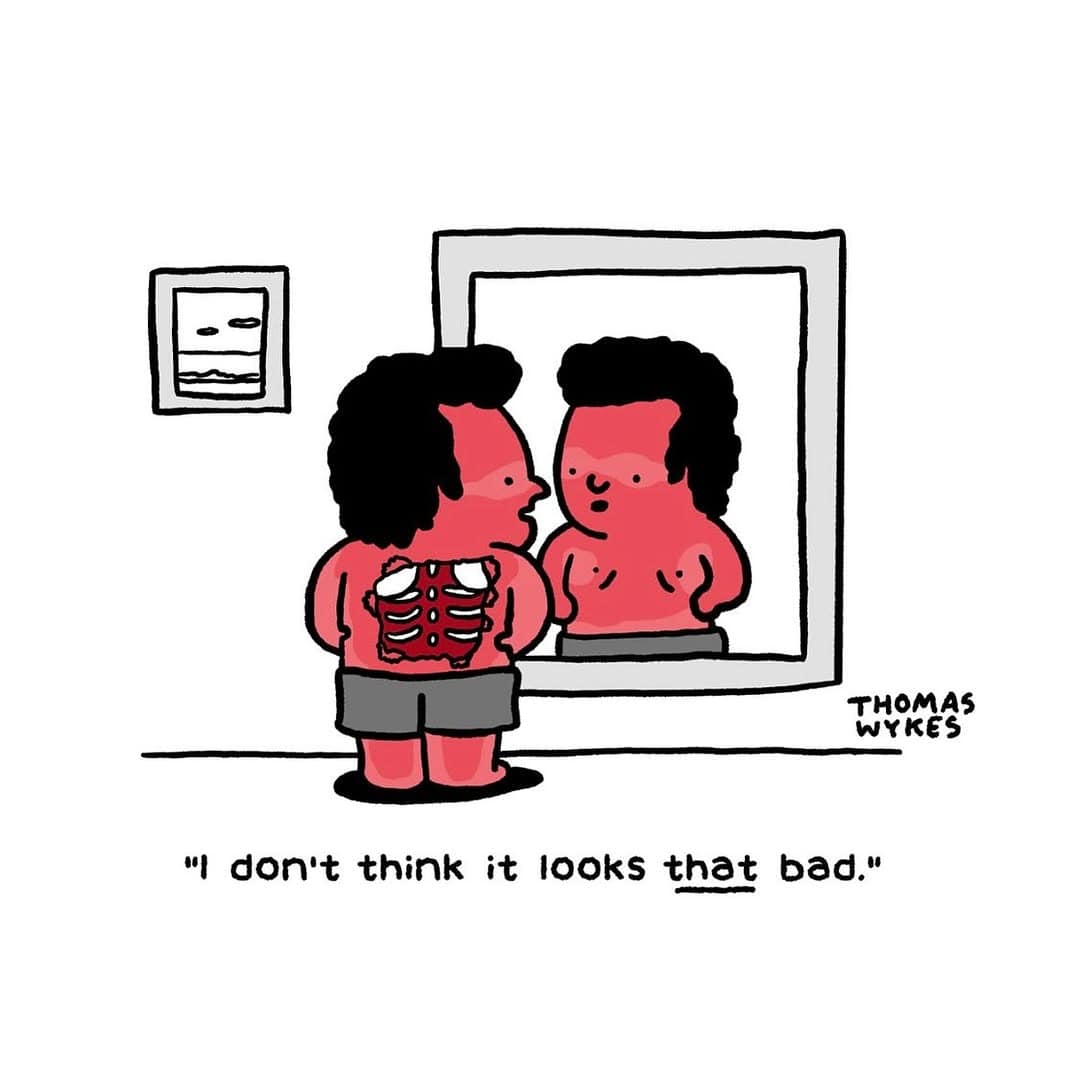 Sunburned man stares at ribs showing through his chest