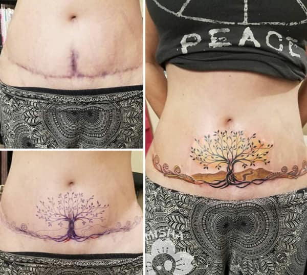 Tree of life tattoo cover up transforming abdominal scar into colorful landscape design.