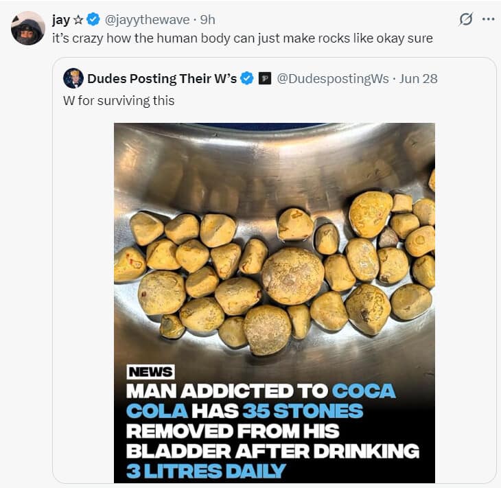 A hilarious meme and viral tweet reacting to a "35 bladder stones" story by saying, "it's crazy how the human body can just make rocks."