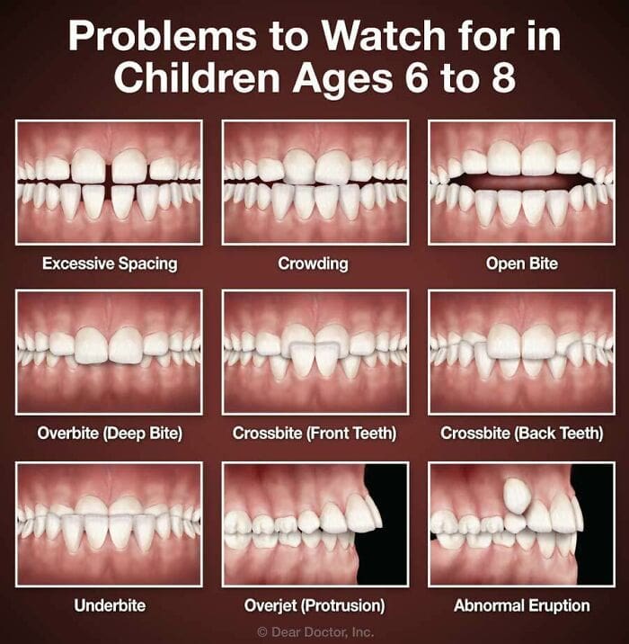 Dental guide illustrating common orthodontic problems to watch for in young children.