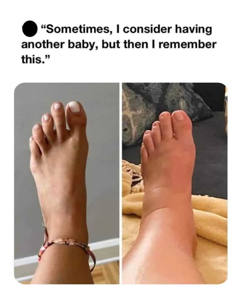 Comparison of normal foot versus swollen pregnancy foot parenting meme.