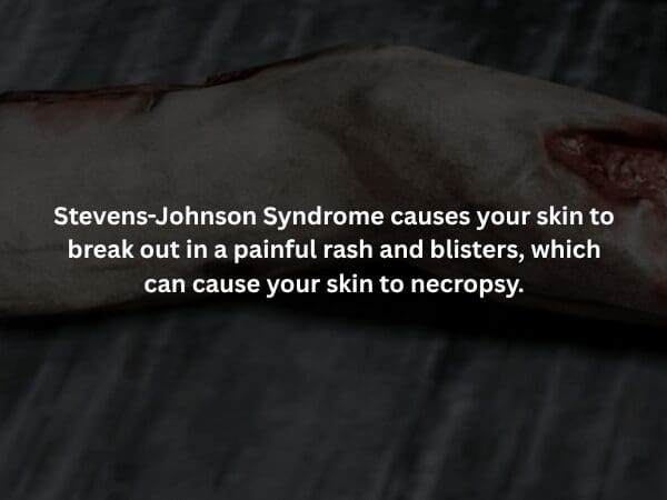 creepy fact warning about Stevens-Johnson Syndrome, showing a dark close-up of blistered skin where the tissue is beginning to undergo necropsy.