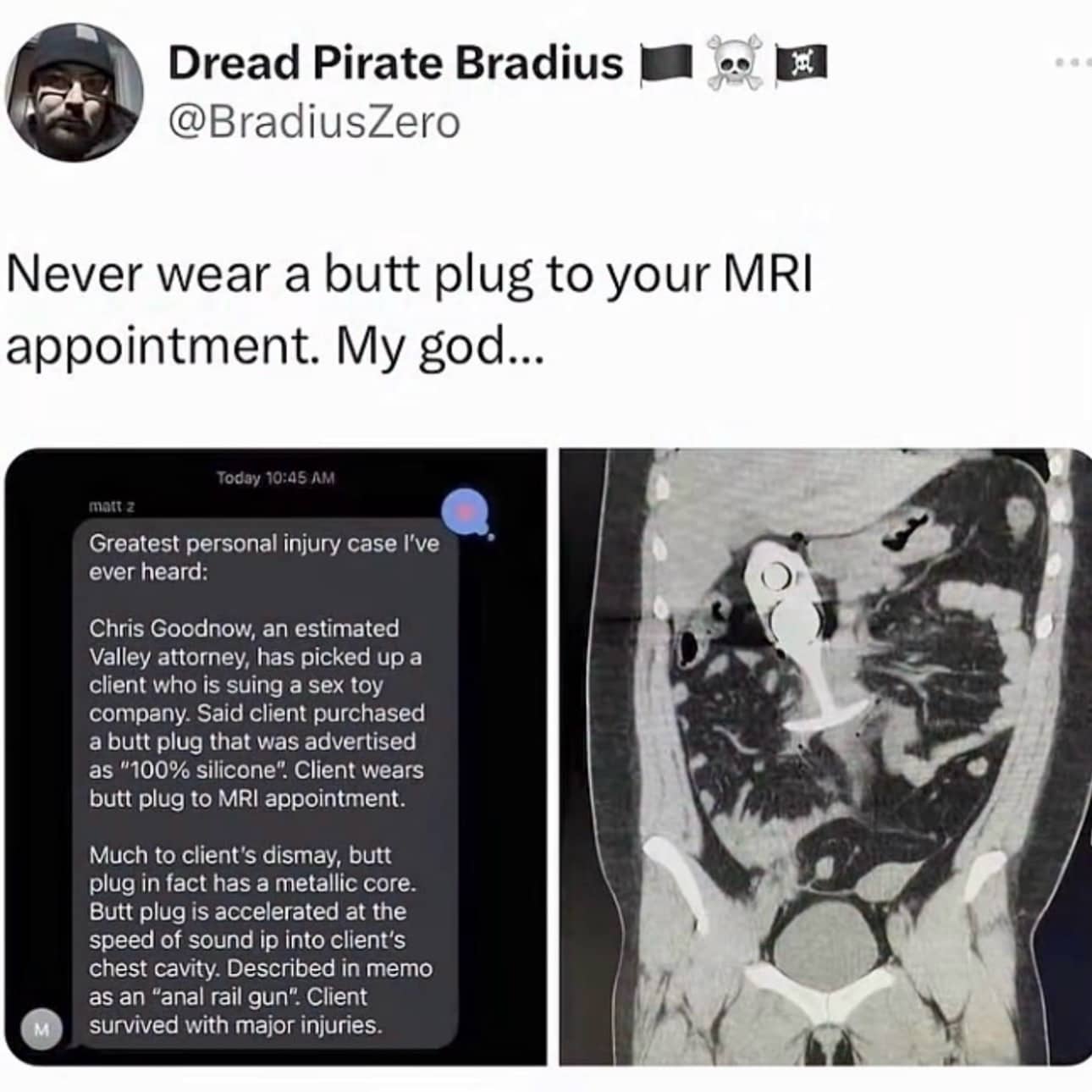 X ray medical scan image showing an object inside a patient with text commentary.