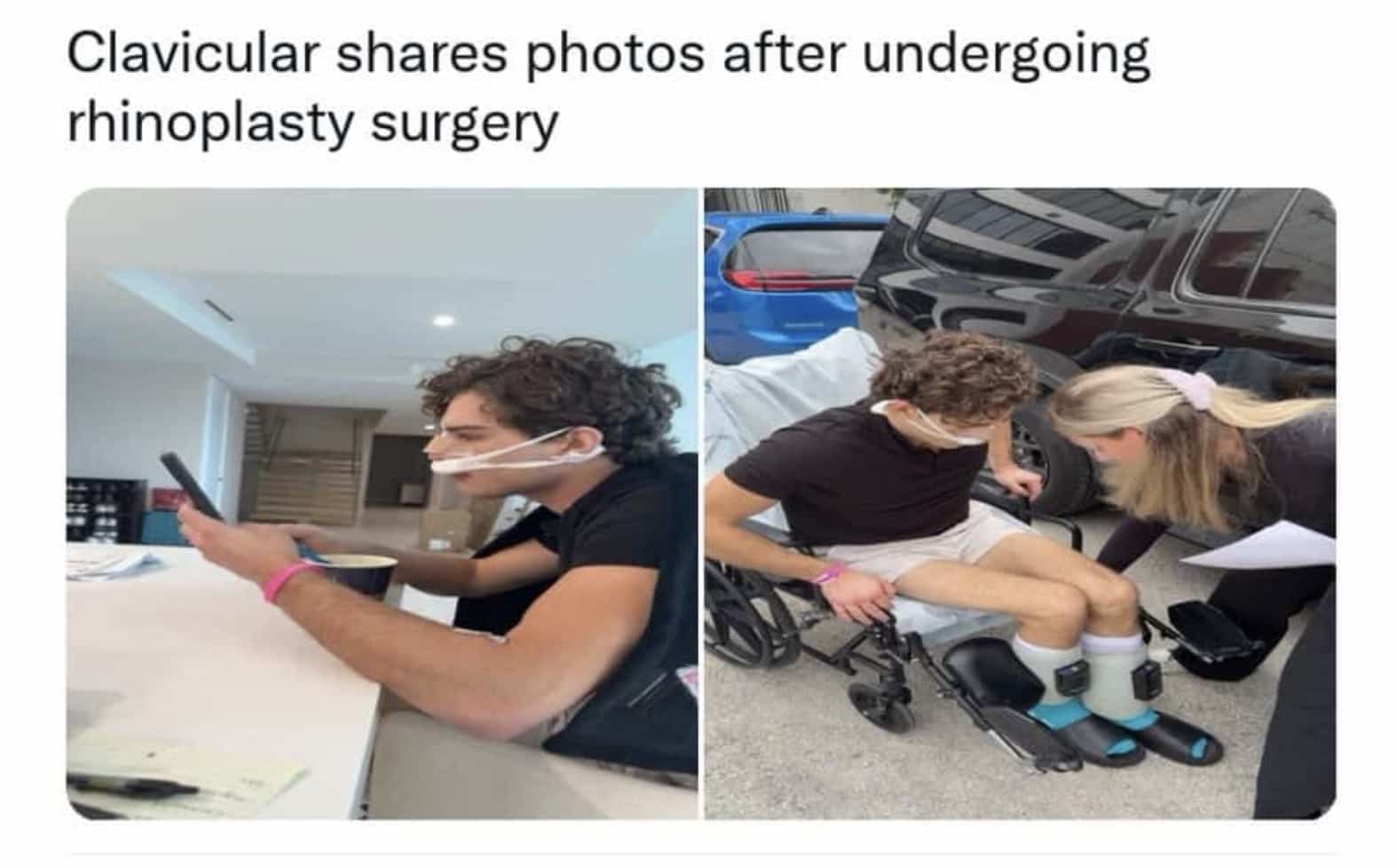 Man wearing ankle monitor house arrest bracelets jokingly claims he just underwent a rhinoplasty surgery.
