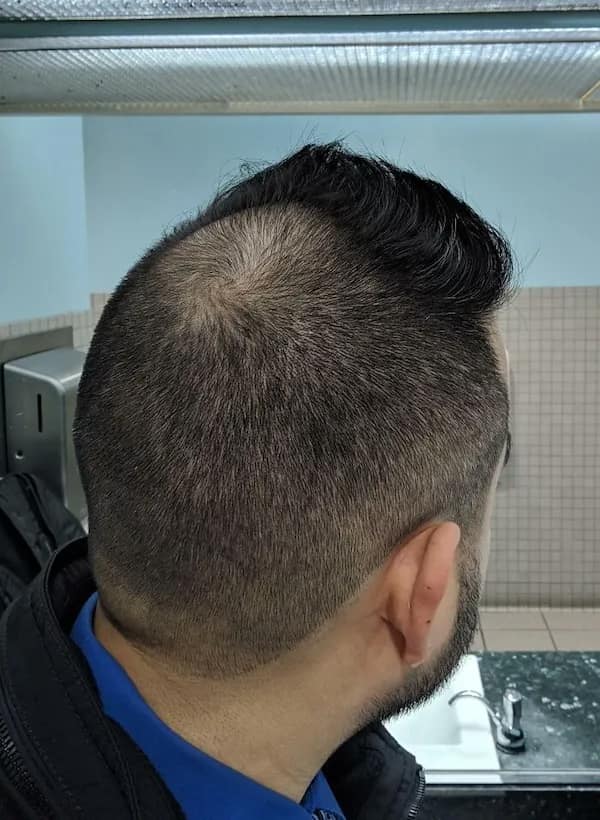 Man's head from behind showing a circular bald spot clipper mistake on the crown, a textbook haircut fail.