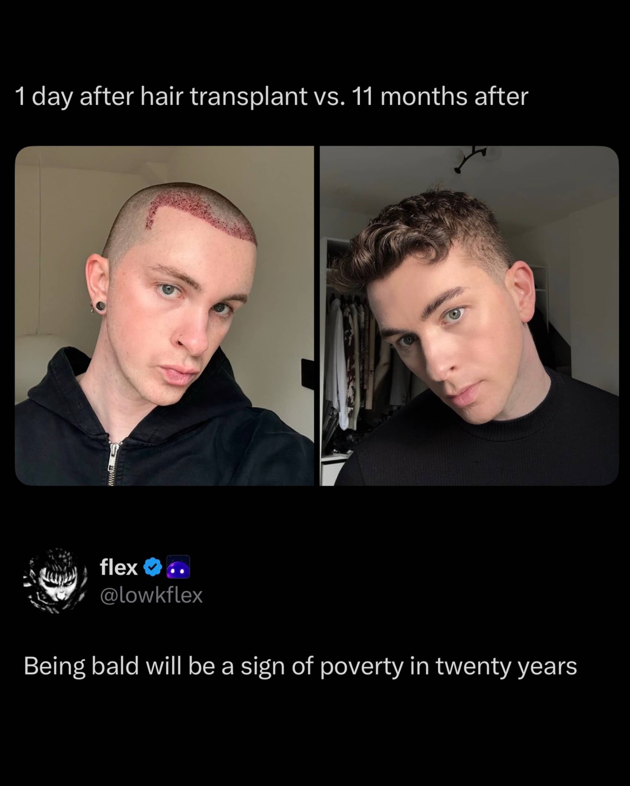 Side by side photos showing the dramatic results of a hair transplant after eleven months.
