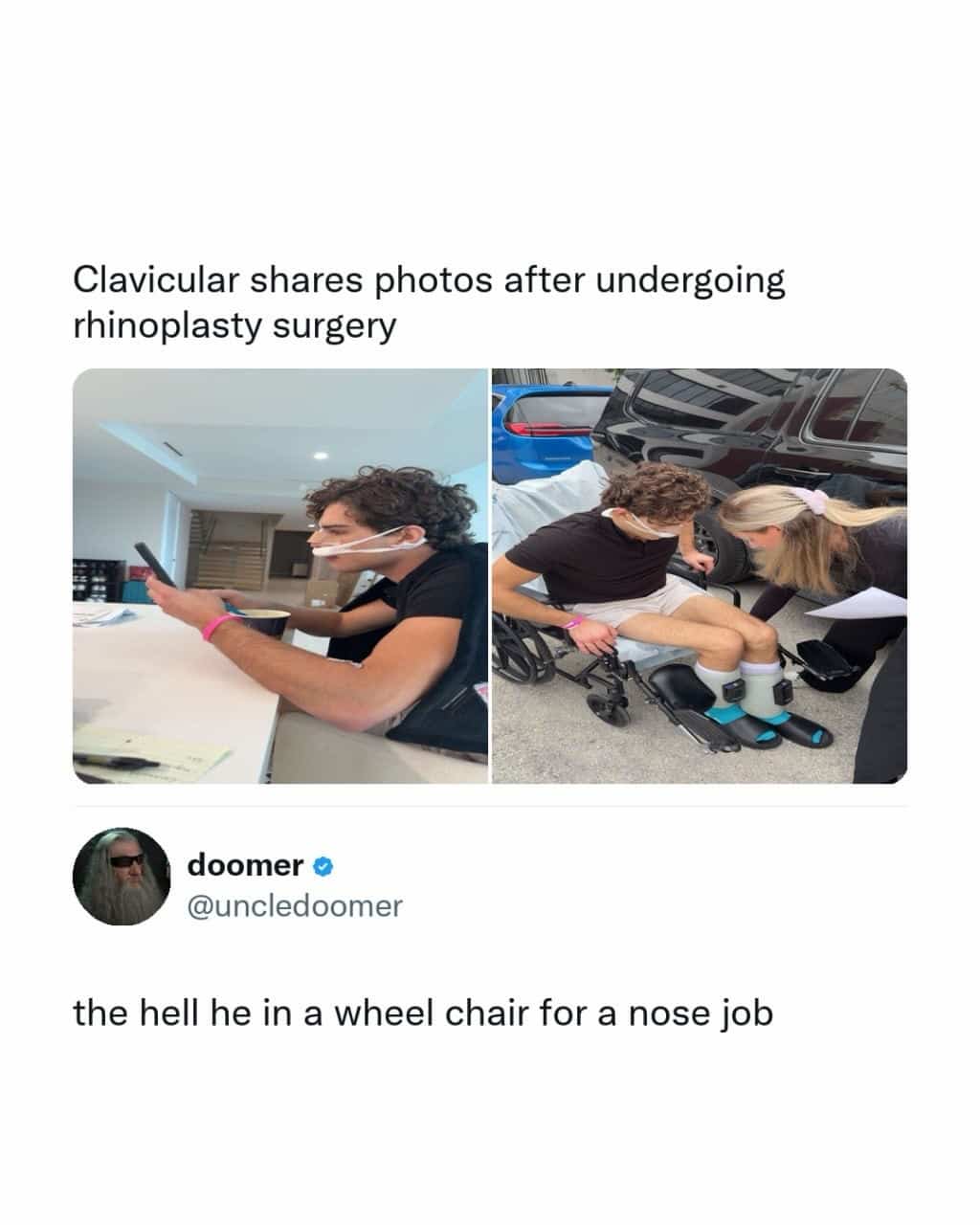 Side-by-side photos of a man after rhinoplasty surgery sitting in a wheelchair.