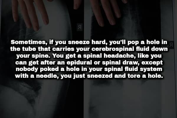 Medical X-ray images showing hands on a screen with text explaining sneeze induced spinal tears.