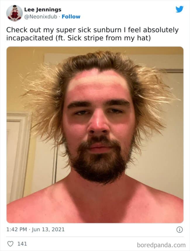 A social media screenshot selfie of a man with wild hair showing a bright red facial burn bisected by a stark white stripe from a baseball hat, organized in a sunburn meme.