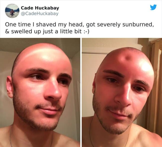 A two-panel Twitter photo update showing a bald man's severe head sunburn that has swollen up to the point of leaving a deep physical dent when pressed with a finger, showcased in a sunburn meme.