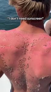 A portrait from behind of a person with an intensely red back covered in thick, heavily peeling sheets of skin under an ironic sunscreen refusal quote within a sunburn meme.