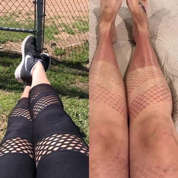 Side-by-side photograph showing a person wearing patterned fishnet leggings next to the resulting checkered diamond lattice skin marks left behind in a painful sunburn meme.