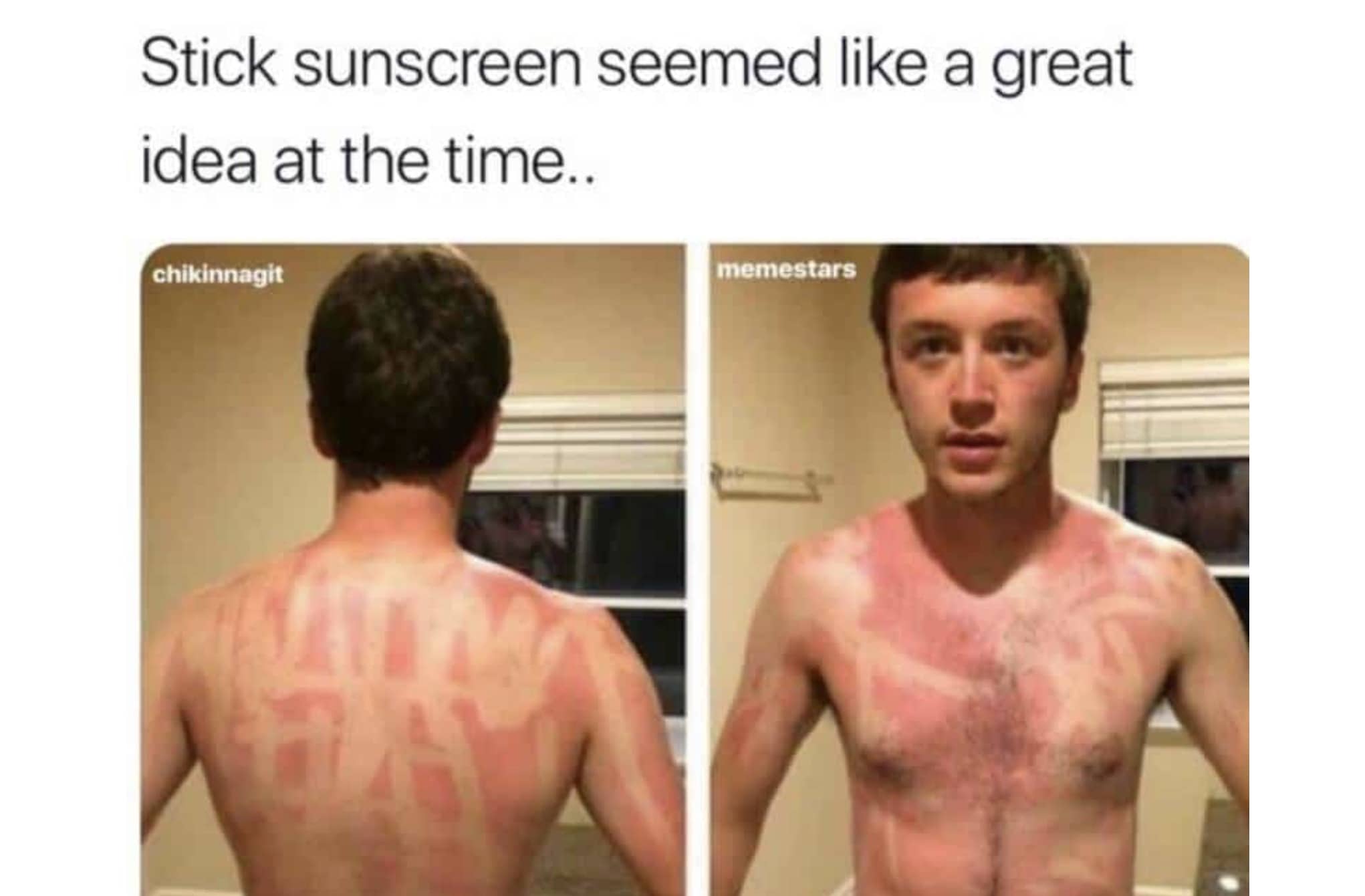 Man with a severe sunburn showing streaks from poorly applied stick sunscreen on chest and back.