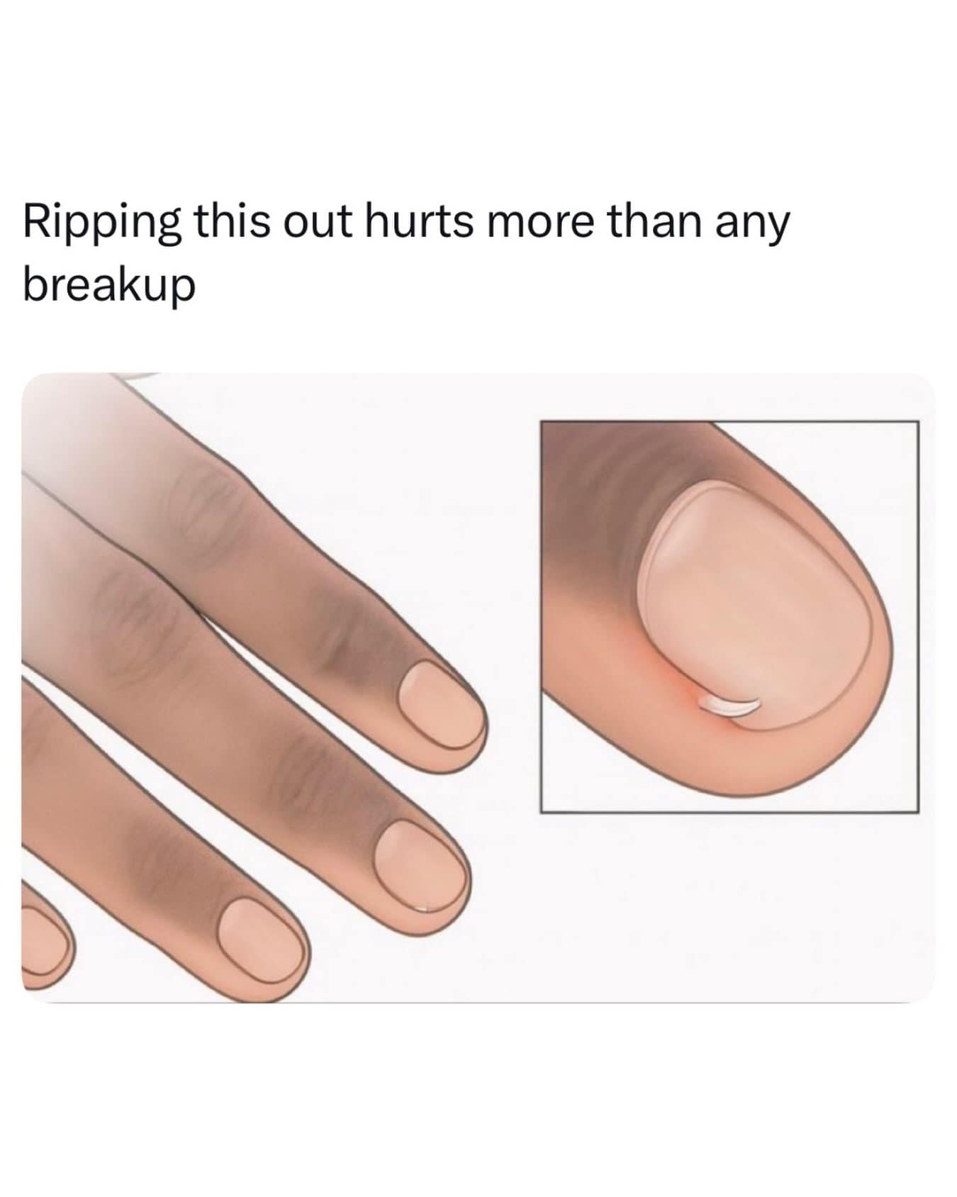 A painful graphic illustration in the meme dump shows a close-up of a finger with a small, raw hangnail or skin tear near the nail bed, with text stating that ripping it hurts more than any breakup.